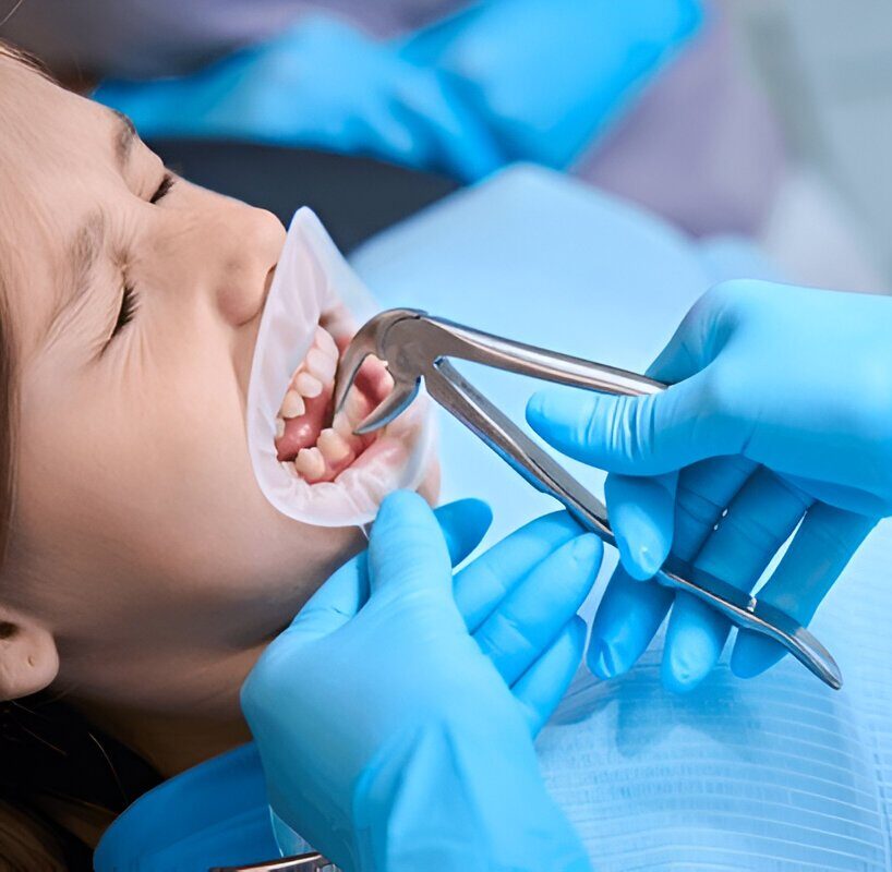 Tooth Extraction Edmonton